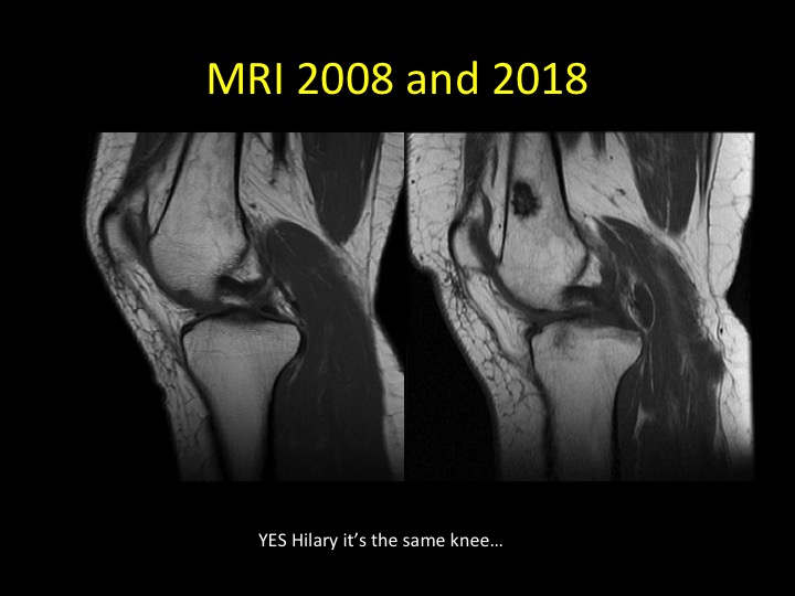 Figure 5 for case bone island ( RID4004 )